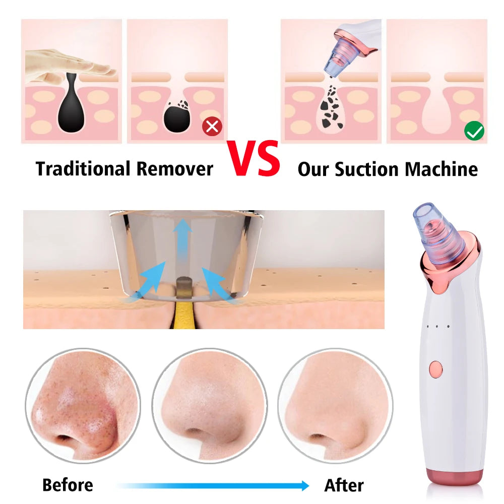 Vacuum Blackhead Removal