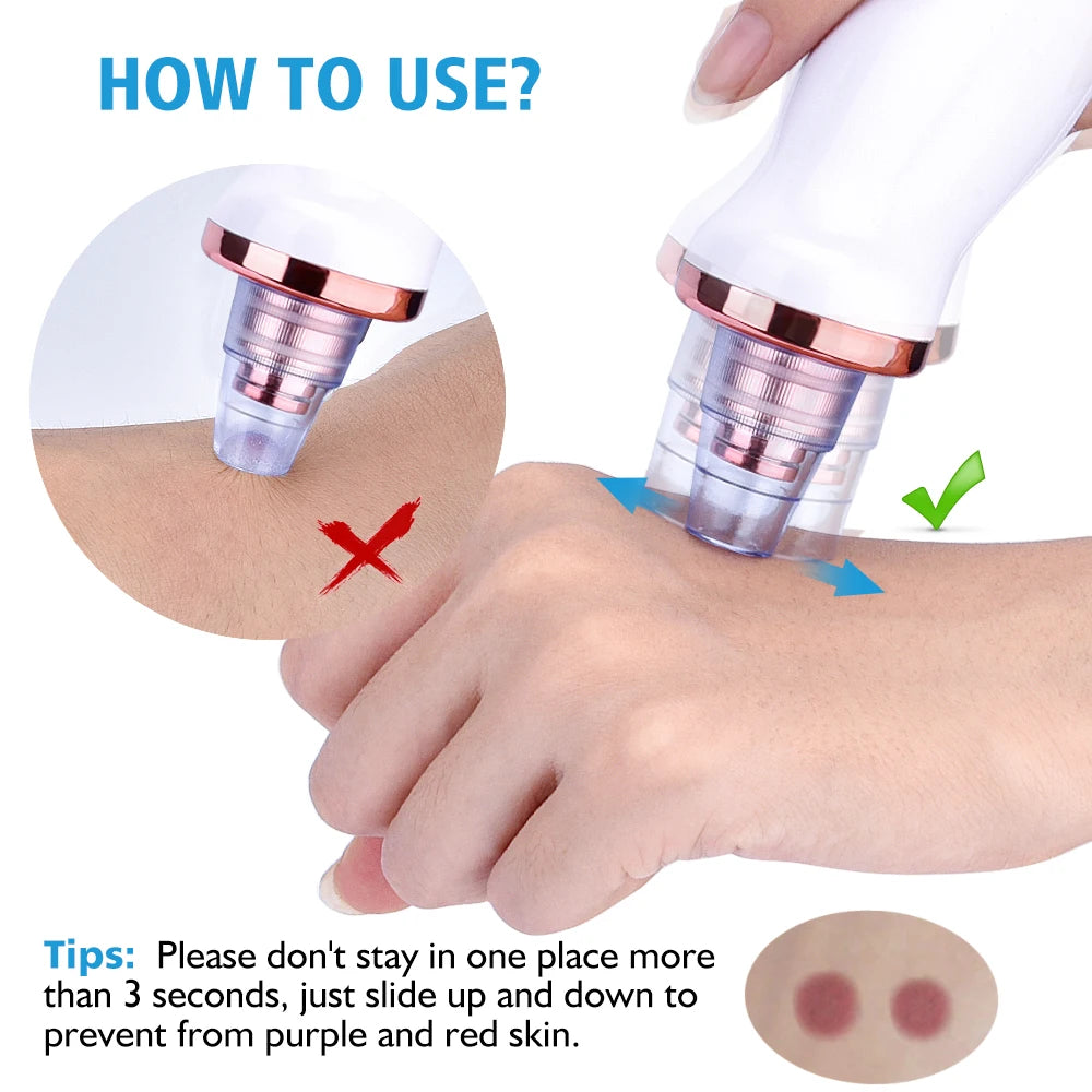 Vacuum Blackhead Removal